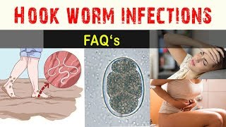 Hook worm Infections  FAQ and Answers [upl. by Ahsuas958]