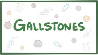 Gallstones cholelithiasis [upl. by Beryle]