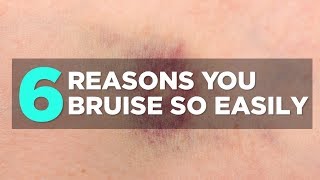 6 Reasons You Bruise So Easily  Health [upl. by Dadelos]