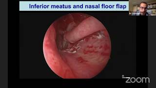 Septal Perforation Repair  How I Do It [upl. by Nwahc]