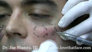 Cheek Filler Injection Made Easy [upl. by Rainwater]