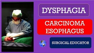 Esophageal Cancer My Journey 10 [upl. by Dammahom324]