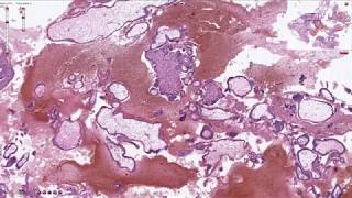 Products of Conception  Histopathology [upl. by Fesoj371]