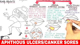 Ulcer Causes Signs and Symptoms Diagnosis and Treatment [upl. by Iseabal]