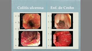 Colitis ulcerosa Vs Enfermedad de Crohn [upl. by Akiehs]