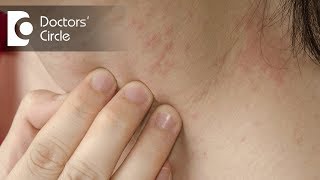 How to Cure ITCHY SKIN  ITCHING  PRURITUS  100 Medical Science in ENG  DrEducation [upl. by Dinsmore]