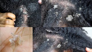 My Seborrheic Dermatitis my scalp up close [upl. by Monteith]