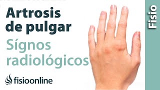 Rizartrosis o artrosis del pulgar  Signos radiológicos [upl. by Lardner]