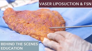 The Science Behind Vaser Liposuction How Does It Work [upl. by Panayiotis378]