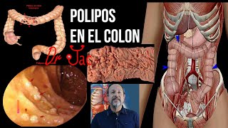 Pólipos en el colon [upl. by Felicia]