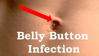 How to Treat Belly button Infection [upl. by Schnurr]