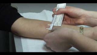 TB Skin Test  Mantoux Method [upl. by Ellevehc]