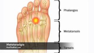 Metatarsalgia Foot Pain Causes Symptoms amp Treatments [upl. by Ahtis]