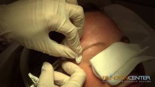 Filler for Forehead Wrinkles procedure [upl. by Kjersti]