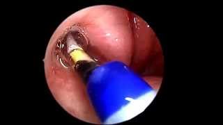 Eustachian Tube Balloon Dilation [upl. by Atirma]