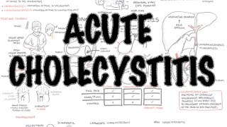 Acute Cholecystitis  Overview signs and symptoms pathophysiology treatment [upl. by Bryanty693]