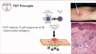 Tuberculosis Diagnosis [upl. by Bilac]