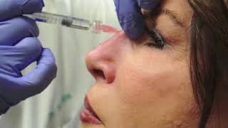 Nonsurgical Rhinoplasty [upl. by Asiat871]