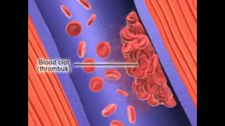 Formation of Deep Vein Thrombosis [upl. by Hutt]