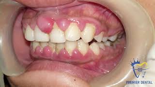 Severe gingivitis amp gingival hyperplasia [upl. by Geldens52]