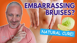 BRUISES How to get rid of them Fast  Dr Doug Willen [upl. by Kcinimod]