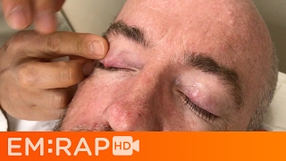 Chalazion Injection [upl. by Nitas]