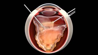 Retinal Detachment  Signs Symptoms and Treatment [upl. by Awuhsoj215]