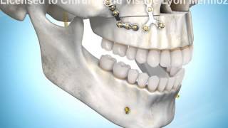 Chirurgie orthognatique sourire gingival traitement [upl. by Airot508]