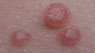 How to treat Molluscum Contagiosum [upl. by Annawot]