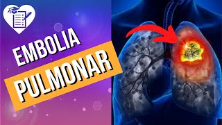 EMBOLIA PULMONAR – Causas Sintomas e Tratamento [upl. by Jezabelle]