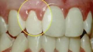 Periodontal Disease amp Treatment [upl. by Llertal377]