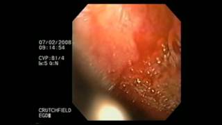 Esophagogastroduodenoscopy [upl. by Santos]