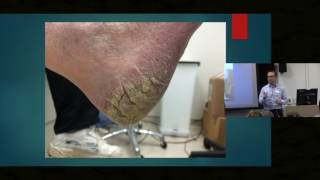 Itch in Elderly Skin  Dr Ian Bekker [upl. by Marthe]