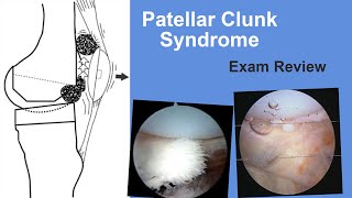 Patellar Clunk Syndrome Exam Review  Matt Austin MD [upl. by Aihsrop]