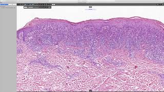 Lichenoid keratosis Phillip H McKee Antonina Kalmykova amp CSD Health Care [upl. by Camilla]