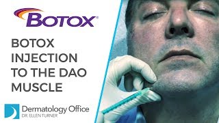 The DAO Muscle  BOTOX® Injections in Dallas [upl. by Ferrand]