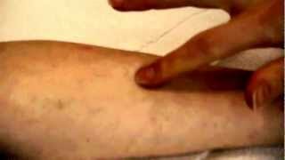 How to take a TB Skin Test [upl. by Paddie]