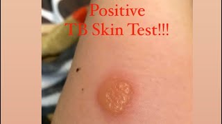 POSITIVE TB SKIN TEST [upl. by Guntar212]