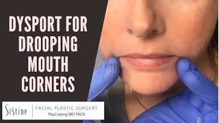 Dysport Injections to DAO Muscle for Drooping Mouth Corners [upl. by Jena]