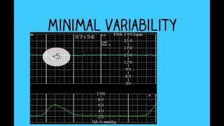 Topic 26 Intrapartum Fetal Surveillance [upl. by Akienom]