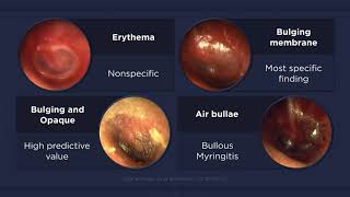 Acute Otitis Media Otoscopic Findings [upl. by Lavena201]