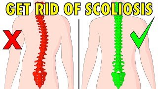 Scoliose 1 an postopération  Scoliosis QampA [upl. by Melosa232]