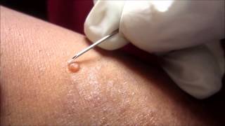 Removing H P Body From Molluscum Contagiosum [upl. by Reichel185]