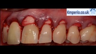 Alloderm Periodontal Surgery for Gum RecessionGraftingRoot CoverageUpper Teeth [upl. by Hesther]