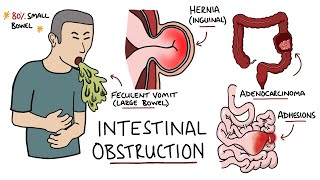 Intestinal Obstruction  Small Bowel Obstruction vs Large Bowel Obstruction [upl. by Garwood588]