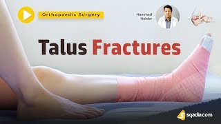 Talus Fractures  Orthopaedic Surgery Lectures  Medical Student  Trailer [upl. by Eloccin]