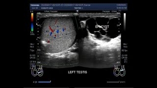 Ultrasound Video showing an Epididymal cyst [upl. by Suryc218]