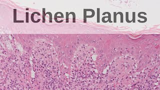 Lichen Planus  Pathology mini tutorial [upl. by Xer]