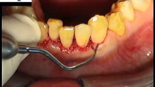 Gingivectomie  secteur antérieur mandibulaire [upl. by Einaffit430]