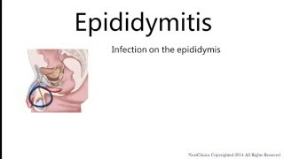 Epididymitis [upl. by Ward]